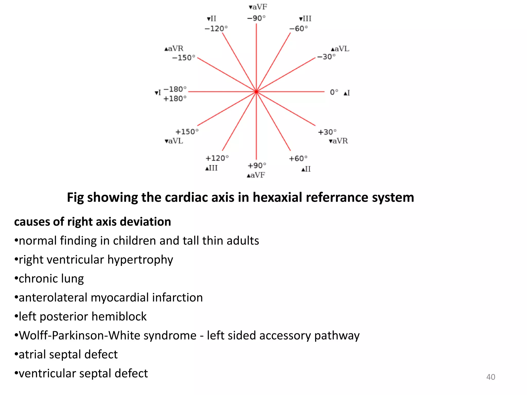 Fig showing the cardiac axis in hexaxial referrance system
causes of right axis deviation
•normal finding in children and tall thin adults
•right ventricular hypertrophy
•chronic lung
•anterolateral myocardial infarction
•left posterior hemiblock
•Wolff-Parkinson-White syndrome - left sided accessory pathway
•atrial septal defect
•ventricular septal defect 40
 