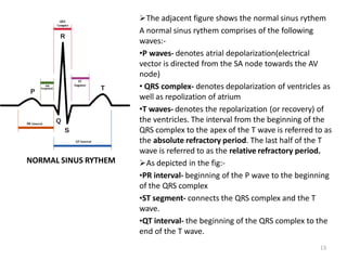 NORMAL SINUS RYTHEM
The adjacent figure shows the normal sinus rythem
A normal sinus rythem comprises of the following
waves:-
•P waves- denotes atrial depolarization(electrical
vector is directed from the SA node towards the AV
node)
• QRS complex- denotes depolarization of ventricles as
well as repolization of atrium
•T waves- denotes the repolarization (or recovery) of
the ventricles. The interval from the beginning of the
QRS complex to the apex of the T wave is referred to as
the absolute refractory period. The last half of the T
wave is referred to as the relative refractory period.
As depicted in the fig:-
•PR interval- beginning of the P wave to the beginning
of the QRS complex
•ST segment- connects the QRS complex and the T
wave.
•QT interval- the beginning of the QRS complex to the
end of the T wave.
13
 