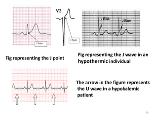 Fig representing the J point
Fig representing the J wave in an
hypothermic individual
The arrow in the figure represents
the U wave in a hypokalemic
patient
16
 
