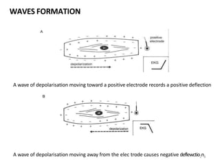 WAVES FORMATION
A wave of depolarisation moving away from the elec trode causes negative deflewctio2n8
A wave of depolarisation moving toward a positive electrode records a positive deflection
 