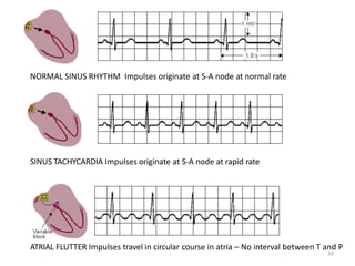 NORMAL SINUS RHYTHM Impulses originate at S-A node at normal rate
33
SINUS TACHYCARDIA Impulses originate at S-A node at rapid rate
ATRIAL FLUTTER Impulses travel in circular course in atria – No interval between T and P
 