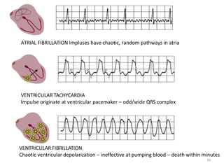 ATRIAL FIBRILLATION Impluses have chaotic, random pathways in atria
34
VENTRICULAR TACHYCARDIA
Impulse originate at ventricular pacemaker – odd/wide QRS complex
VENTRICULAR FIBRILLATION
Chaotic ventricular depolarization – ineffective at pumping blood – death within minutes
 