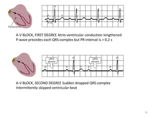 A-V BLOCK, FIRST DEGREE Atrio-ventricular conduction lengthened
P-wave precedes each QRS-complex but PR-interval is > 0.2 s
35
A-V BLOCK, SECOND DEGREE Sudden dropped QRS-complex
Intermittently skipped ventricular beat
 