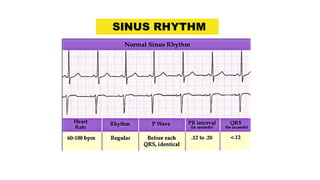 Sinus R1 Ecg presentation | PDF