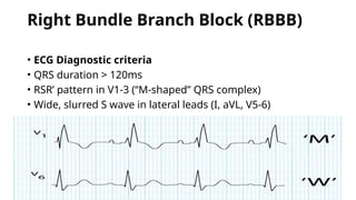 Wide Qrs Rbbb ecg primary care reference for medical professionals | PPTX