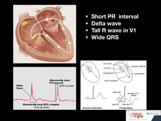 Ecg quiz @ SEMICON 1018 | PDF