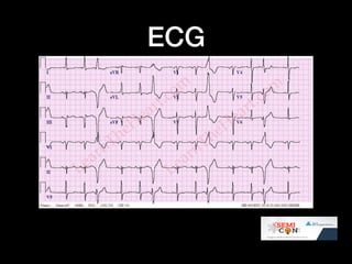 Ecg quiz @ SEMICON 1018 | PDF