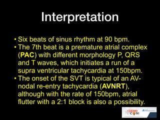 Ecg quiz @ SEMICON 1018 | PDF