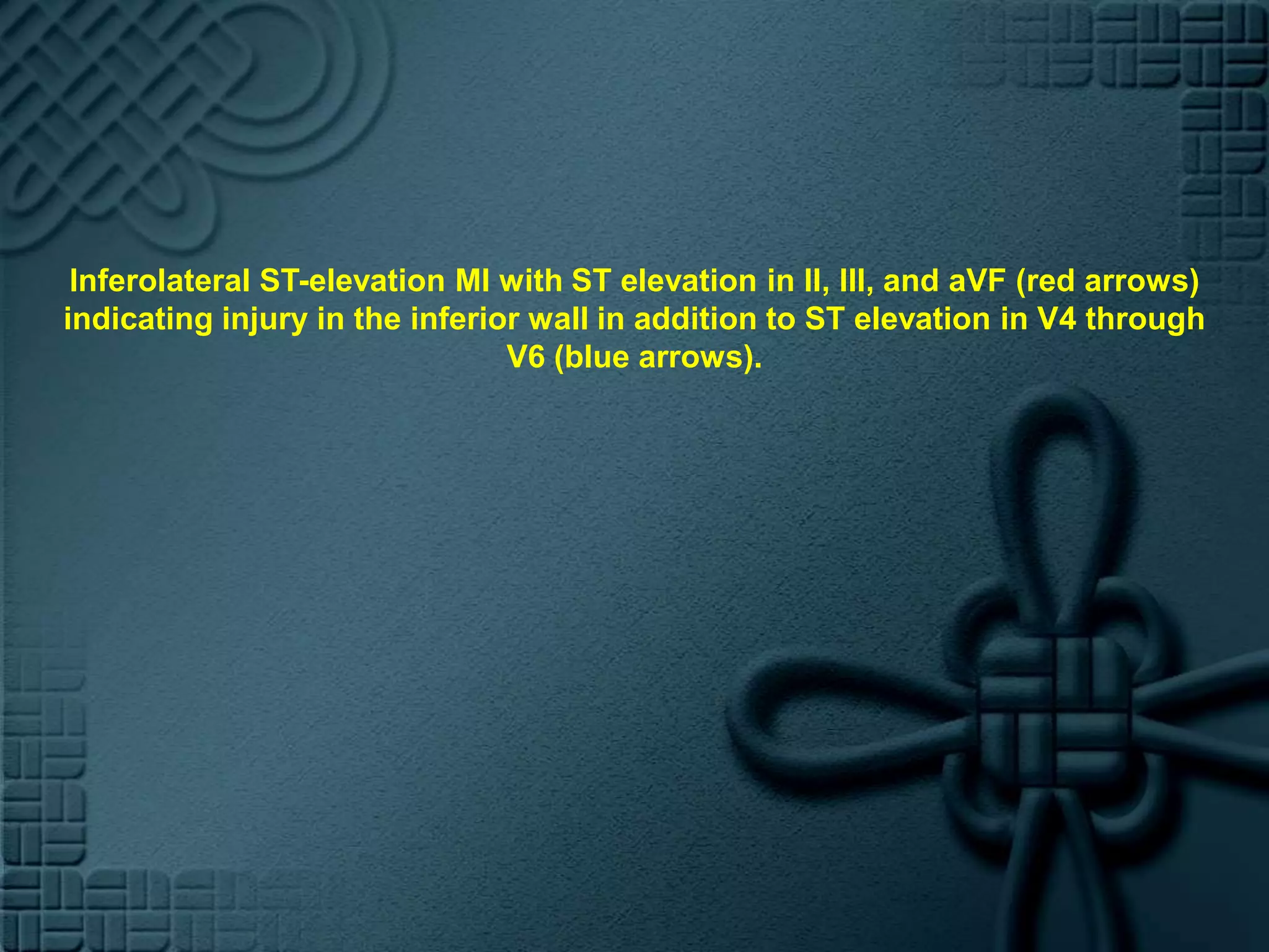 Inferolateral ST-elevation MI with ST elevation in II, III, and aVF (red arrows) indicating injury in the inferior wall in addition to ST elevation in V4 through V6 (blue arrows).