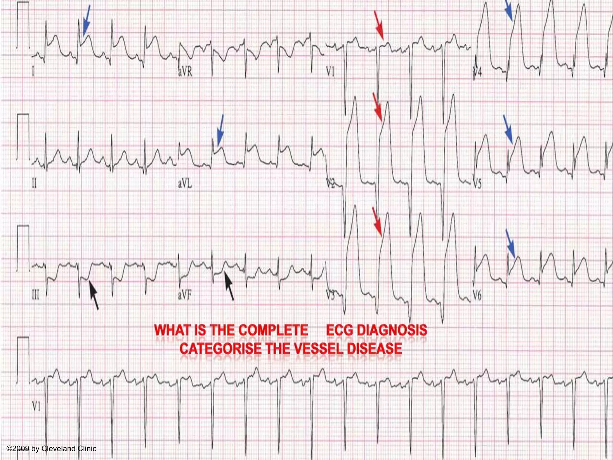 What is the complete     Ecg diagnosisCategorise the vessel disease©2009 by Cleveland Clinic