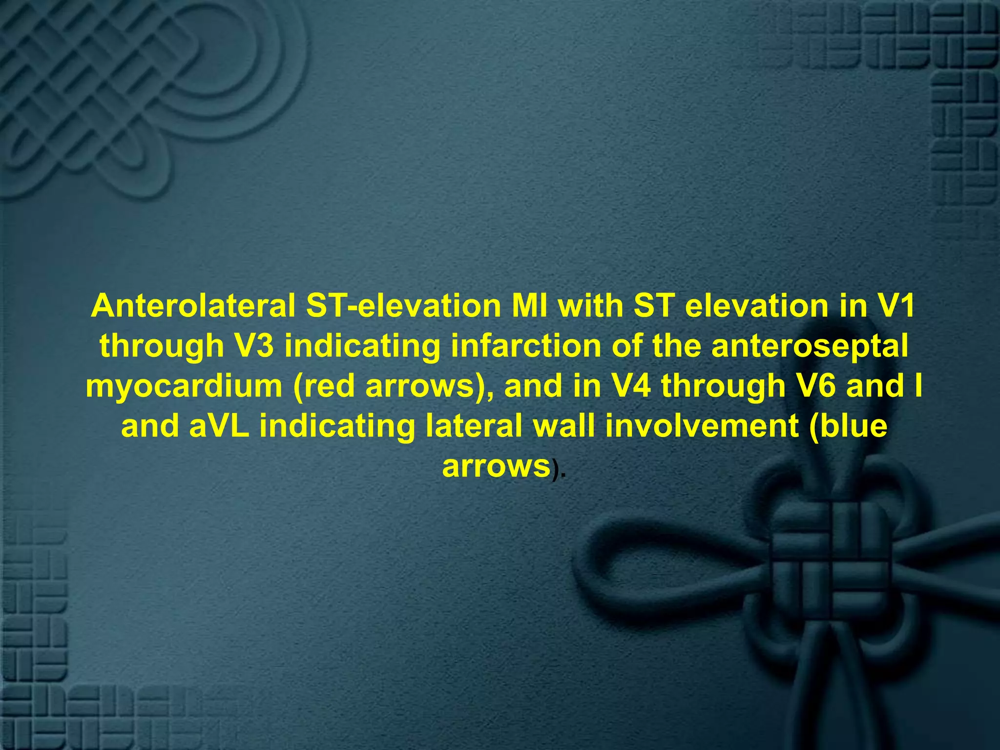 Anterolateral ST-elevation MI with ST elevation in V1 through V3 indicating infarction of the anteroseptal myocardium (red arrows), and in V4 through V6 and I and aVL indicating lateral wall involvement (blue arrows).