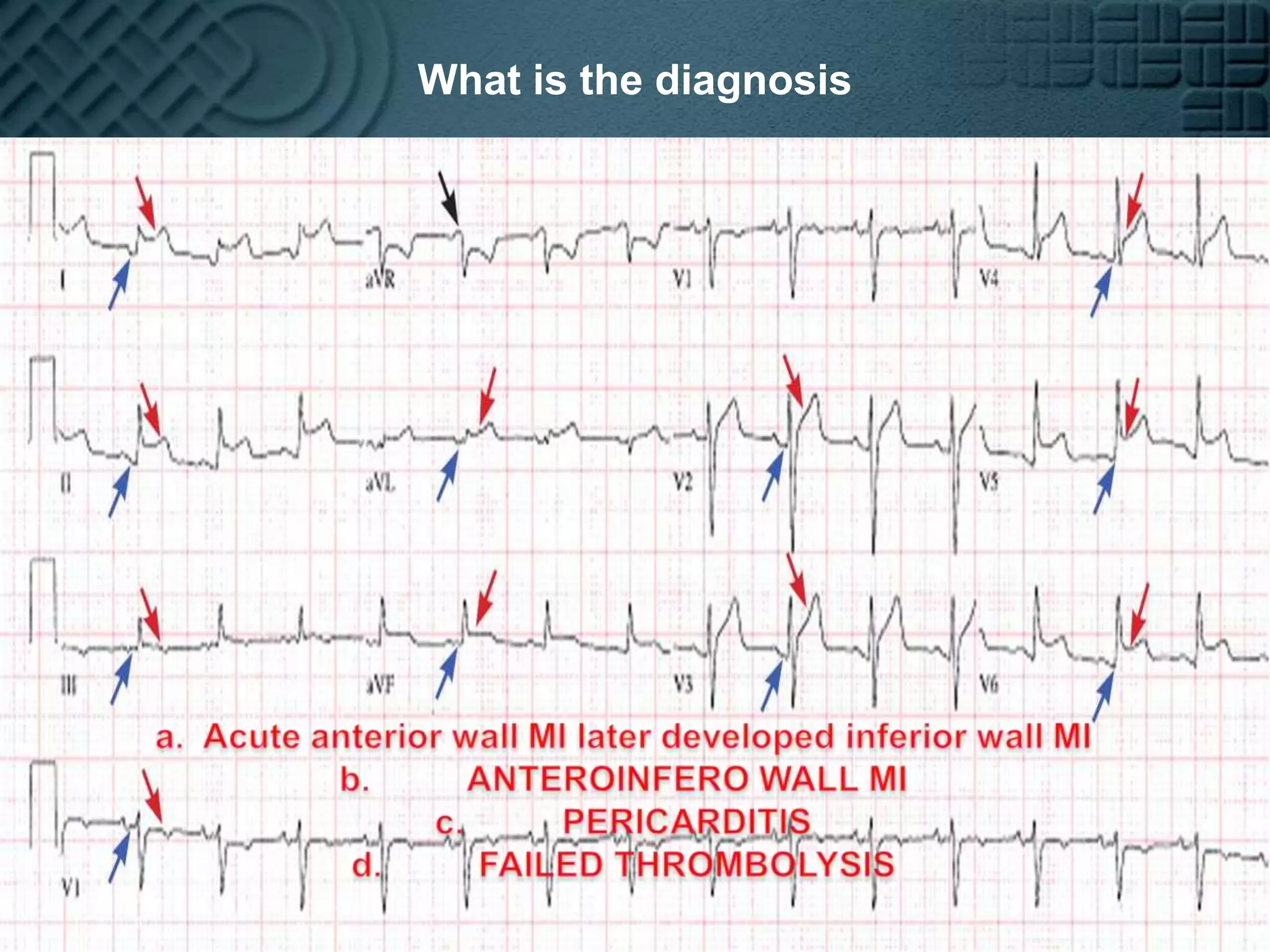 What is the diagnosisAcute anterior wall MI later developed inferior wall MI ANTEROINFERO WALL MIPERICARDITISFAILED THROMBOLYSIS a.Acute MI                  b.Inferoposterior with RVMI             c.Pericarditis                                            d. anterolateral MI who later developed inferior wall MI