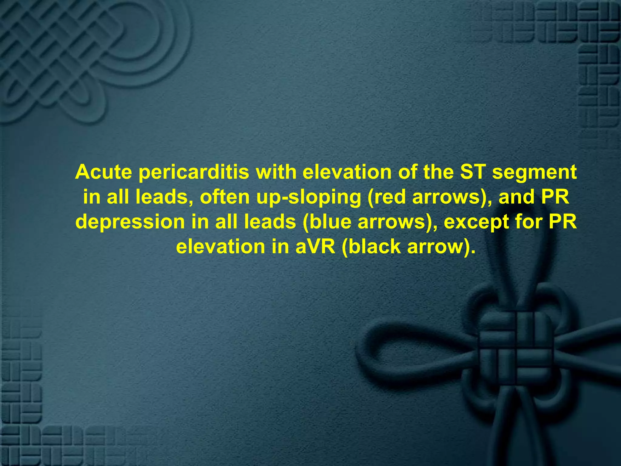 Acute pericarditis with elevation of the ST segment in all leads, often up-sloping (red arrows), and PR depression in all leads (blue arrows), except for PR elevation in aVR (black arrow).