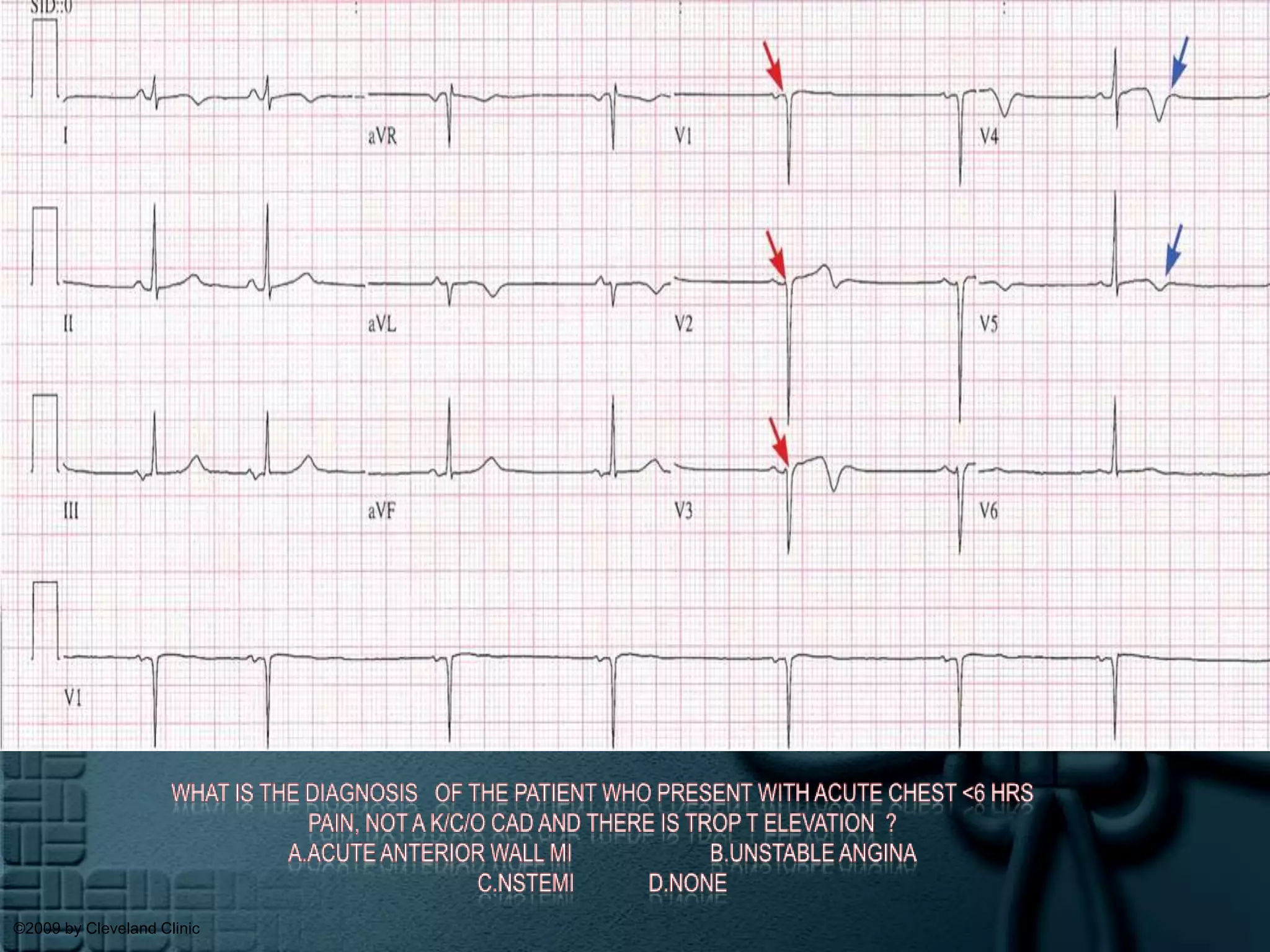 What is the diagnosis   of the patient who present with acute chest <6 hrs Pain, not a k/c/o cad and there is trop t elevation  ?a.Acute anterior wall MI                        b.Unstable anginac.Nstemid.none©2009 by Cleveland Clinic