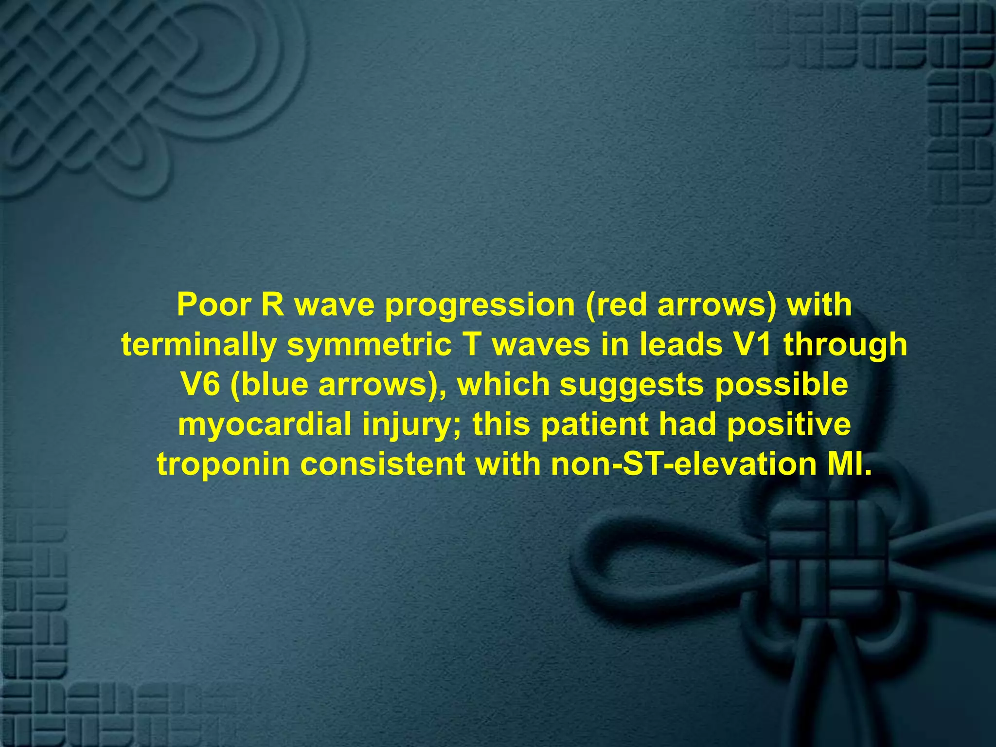 Poor R wave progression (red arrows) with terminally symmetric T waves in leads V1 through V6 (blue arrows), which suggests possible myocardial injury; this patient had positive troponin consistent with non-ST-elevation MI.