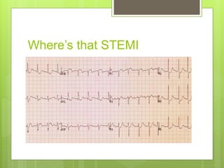 Stemi Practice Test Ecg quiz | PPTX