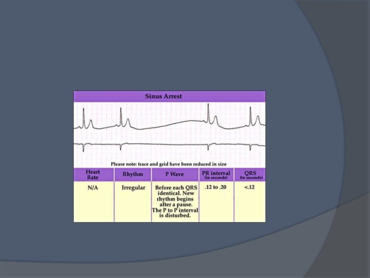 Ecg quiz2