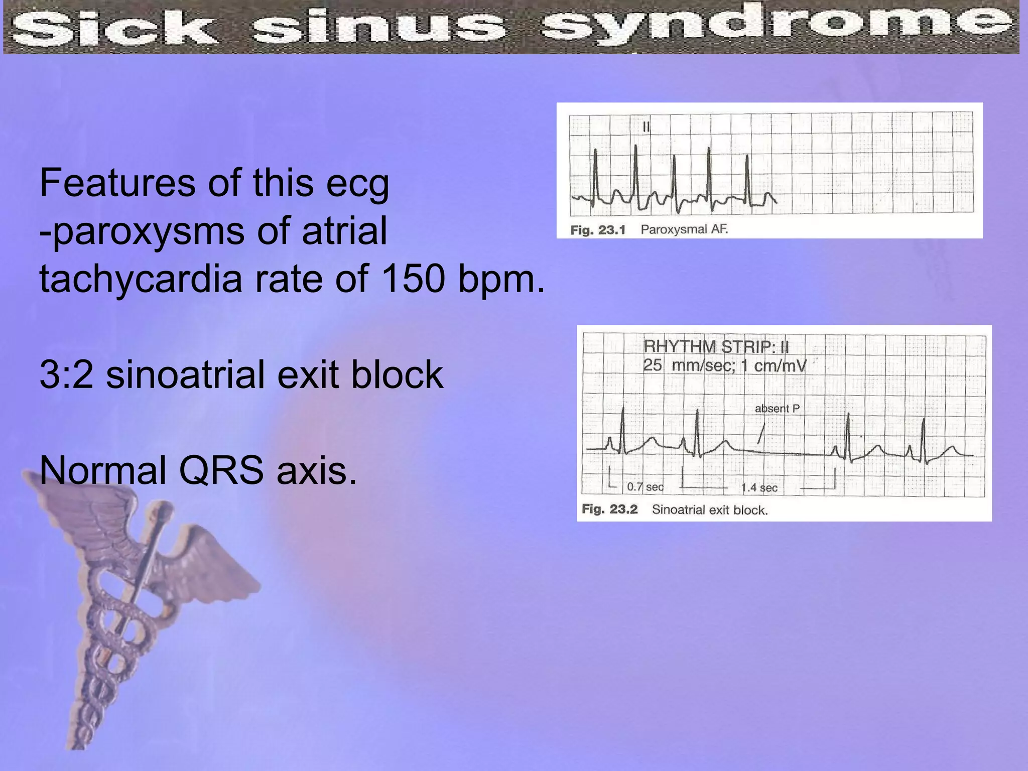 Features of this ecg -paroxysms of atrial tachycardia rate of 150 bpm. 3:2 sinoatrial exit block Normal QRS axis. 