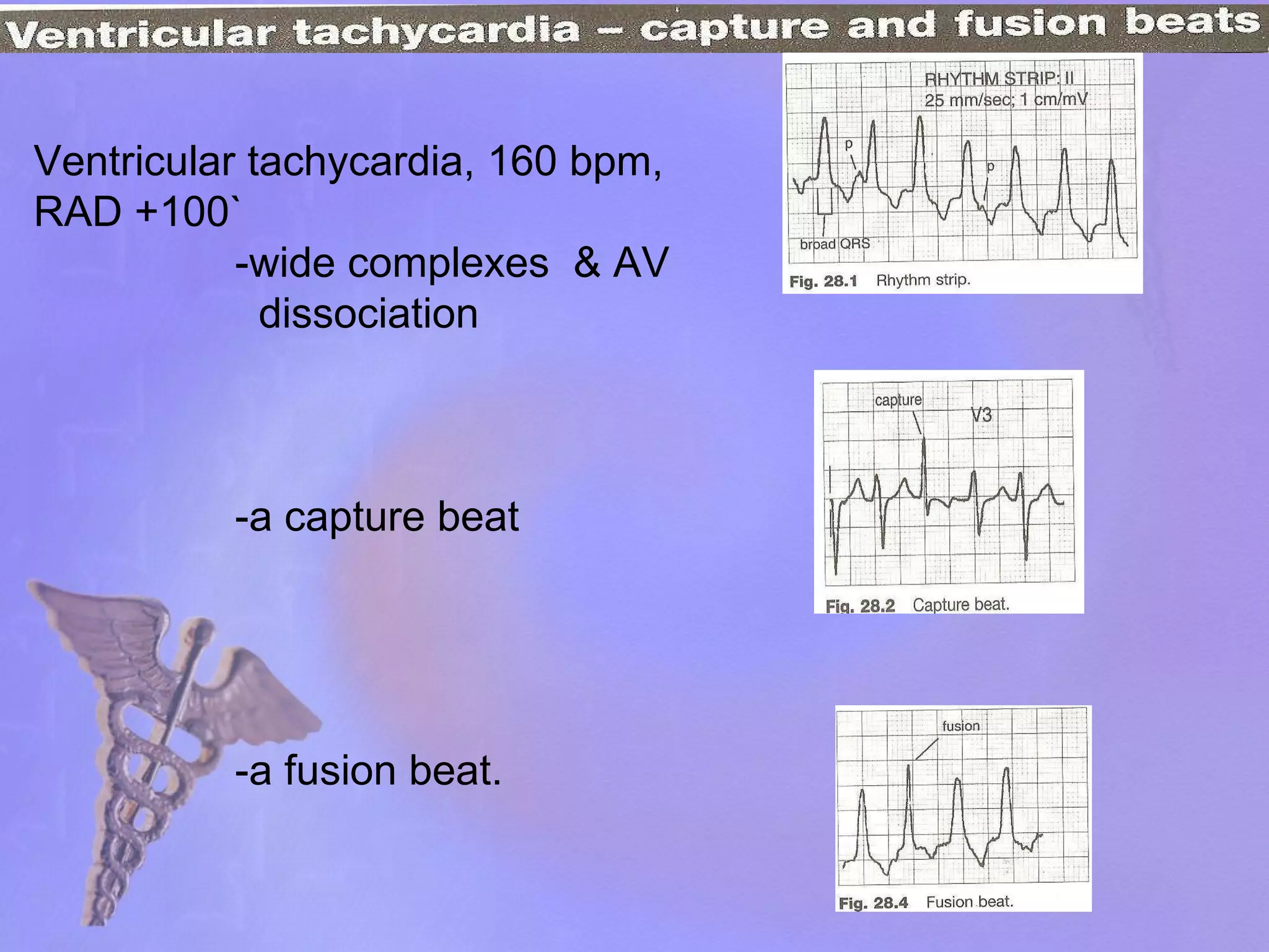 Ventricular tachycardia, 160 bpm, RAD +100` -wide complexes  & AV  dissociation -a capture beat -a fusion beat. 