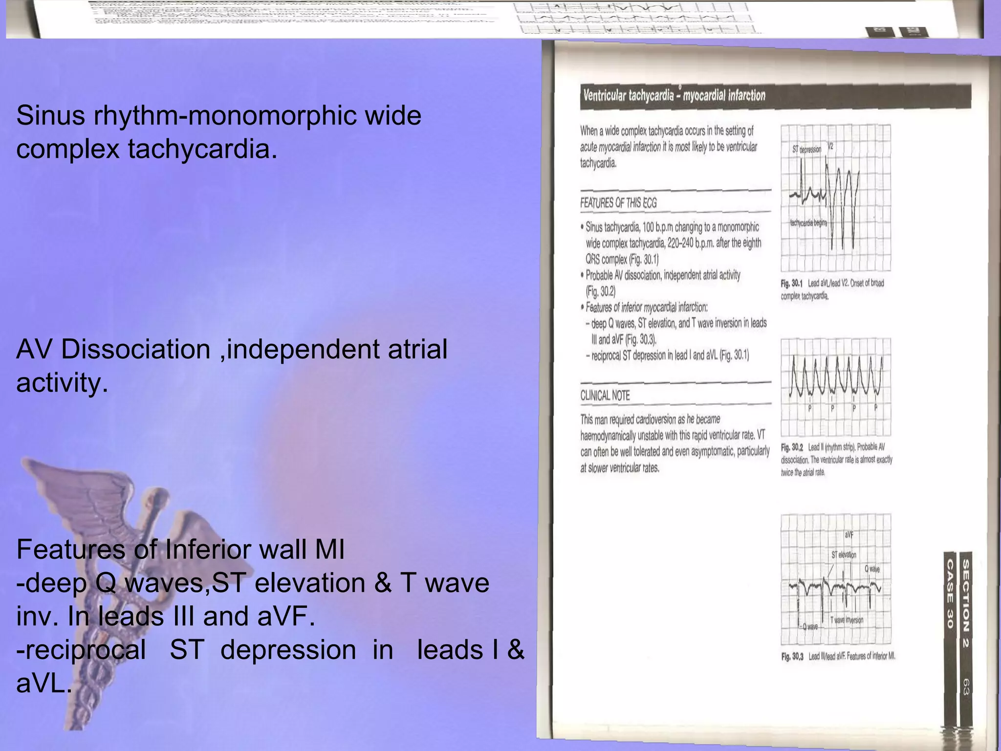 Sinus rhythm-monomorphic wide complex tachycardia. AV Dissociation ,independent atrial activity. Features of Inferior wall MI -deep Q waves,ST elevation & T wave inv. In leads III and aVF. -reciprocal  ST  depression  in  leads I & aVL. 
