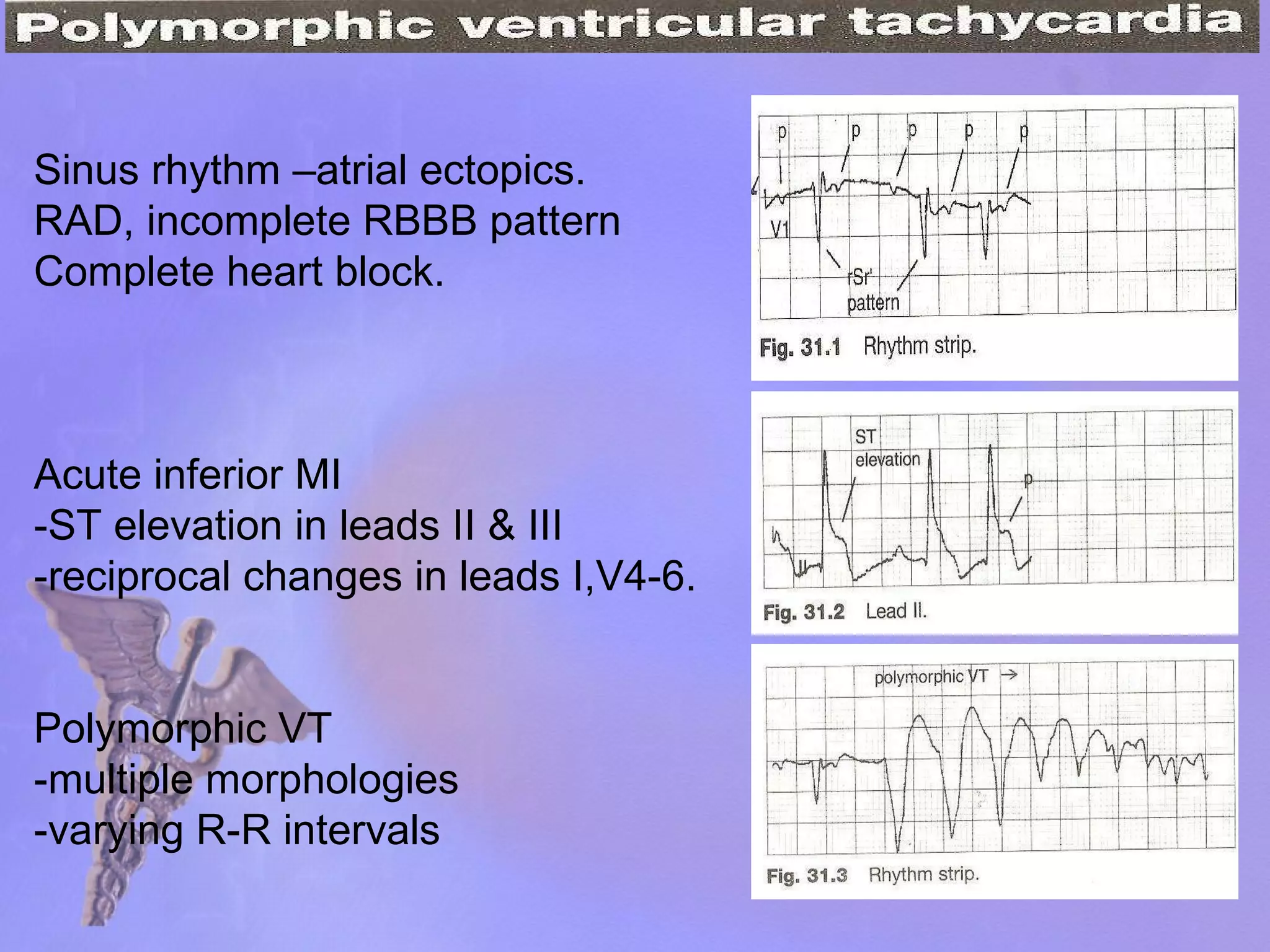 Sinus rhythm –atrial ectopics. RAD, incomplete RBBB pattern Complete heart block. Acute inferior MI -ST elevation in leads II & III -reciprocal changes in leads I,V4-6. Polymorphic VT -multiple morphologies -varying R-R intervals 