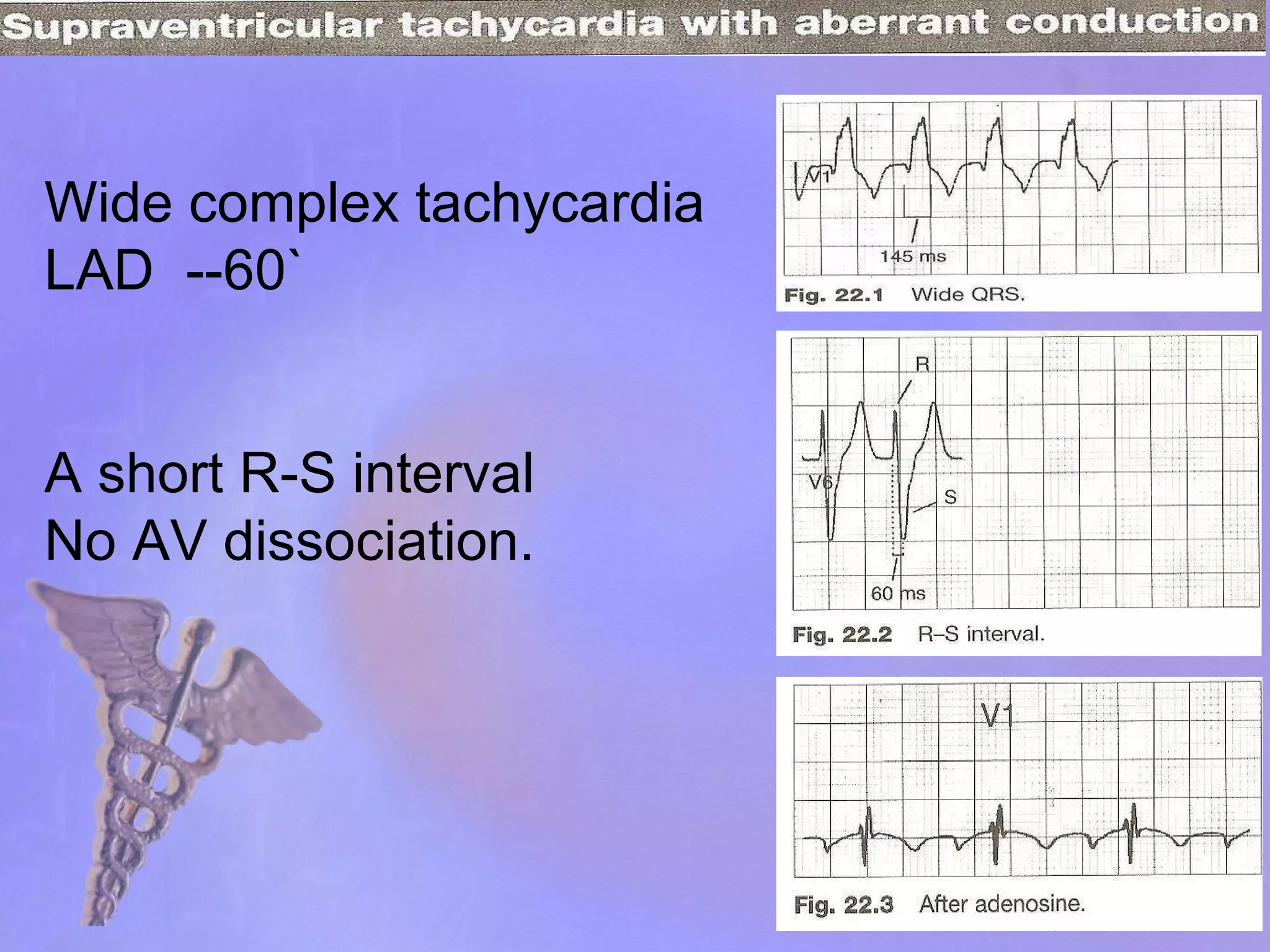 Wide complex tachycardia LAD  --60` A short R-S interval No AV dissociation. 