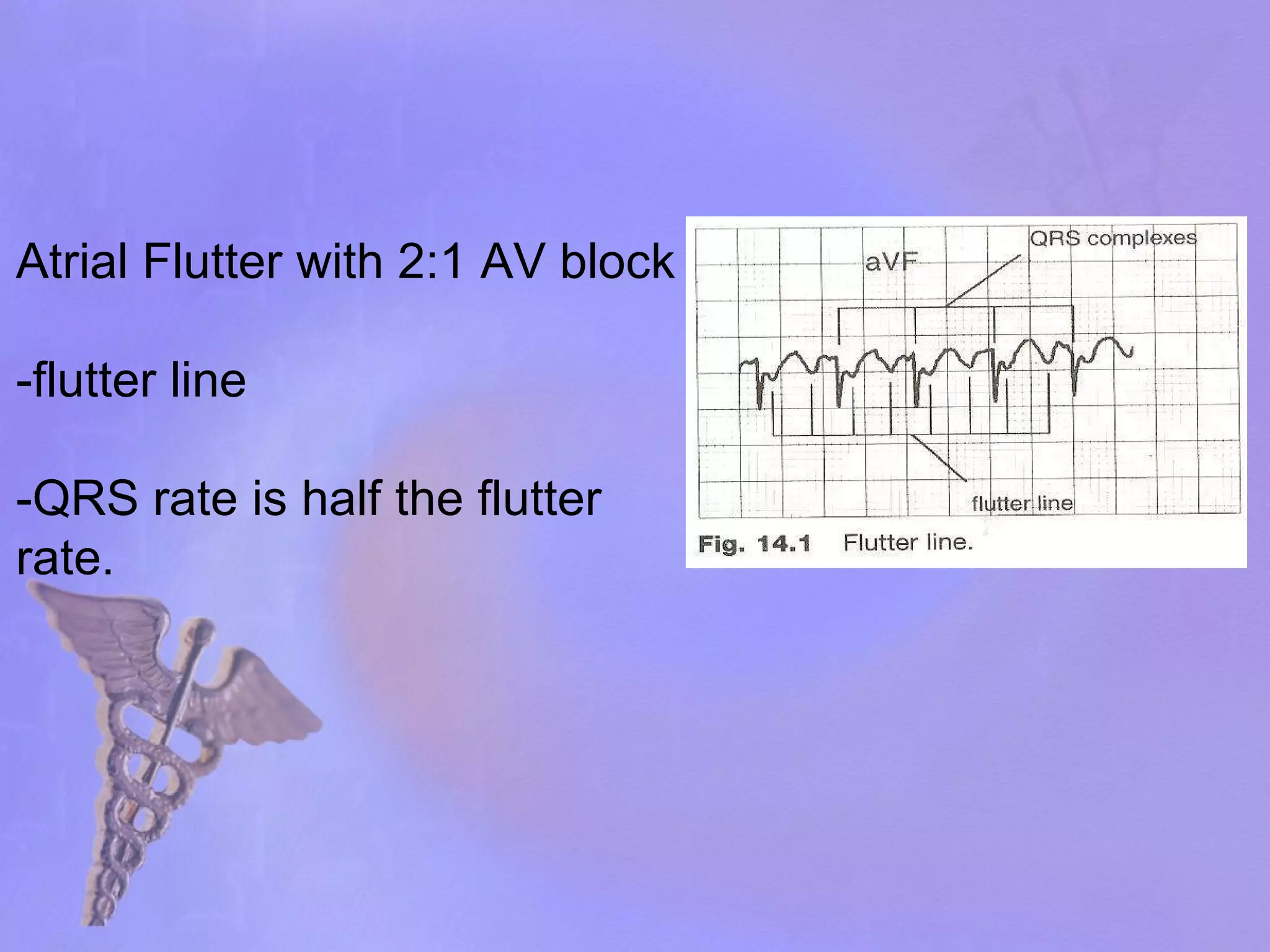 Atrial Flutter with 2:1 AV block -flutter line -QRS rate is half the flutter rate. 