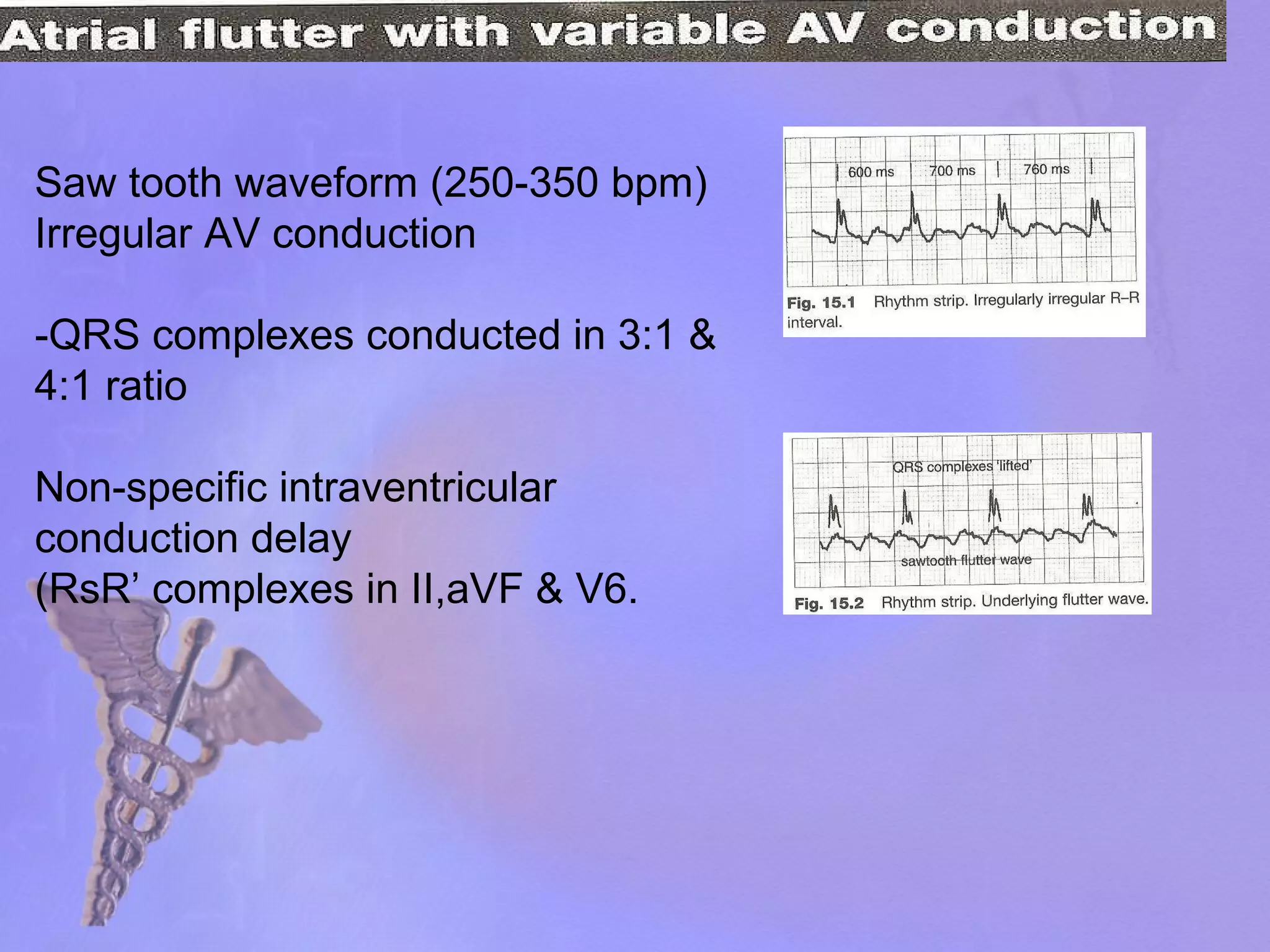 Saw tooth waveform (250-350 bpm) Irregular AV conduction -QRS complexes conducted in 3:1 & 4:1 ratio Non-specific intraventricular conduction delay (RsR’ complexes in II,aVF & V6.  