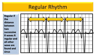 Ecg reading | PPTX
