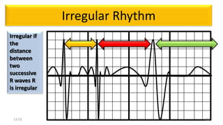 Ecg reading | PPTX