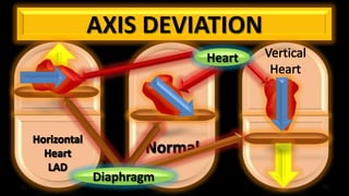Ecg reading | PPTX