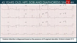 • Posterior infarction is diagnosed based on the presence of ST segment elevation >0.5mm in leads V7-9.
45 YEARS OLD, HPT, SOB AND DIAPHORESIS SINCE 4H
 
