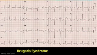 Reference : LITFL ST Segment
Brugada Syndrome
 