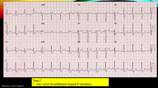 Reference : LITFL ST Segment
Type 2
• Has >2mm of saddleback shaped ST elevation.
 