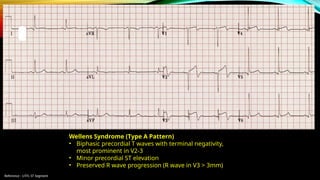 Reference : LITFL ST Segment
Wellens Syndrome (Type A Pattern)
• Biphasic precordial T waves with terminal negativity,
most prominent in V2-3
• Minor precordial ST elevation
• Preserved R wave progression (R wave in V3 > 3mm)
 