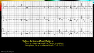 Reference : LITFL ST Segment
Wellens Syndrome (Type B Pattern)
• There are deep, symmetrical T wave inversions
throughout the anterolateral leads (V1-6, I, aVL)
 