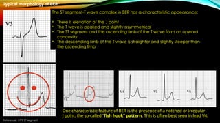 Reference : LITFL ST Segment
Typical morphology of BER
The ST segment-T wave complex in BER has a characteristic appearance:
• There is elevation of the J point
• The T wave is peaked and slightly asymmetrical
• The ST segment and the ascending limb of the T wave form an upward
concavity
• The descending limb of the T wave is straighter and slightly steeper than
the ascending limb
One characteristic feature of BER is the presence of a notched or irregular
J point: the so-called “fish hook” pattern. This is often best seen in lead V4.
 