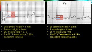 Reference : LITFL ST Segment
• ST segment height = 1 mm
• T wave height = 6 mm
• ST / T wave ratio = 0.16
• The ST / T wave ratio < 0.25 is
consistent with BER
• ST segment height = 2 mm
• T wave height = 4 mm
• ST / T wave ratio = 0.5
• The ST / T wave ratio > 0.25 is
consistent with pericarditis
 