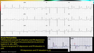 Reference : LITFL ST Segment
Acute Pericarditis:
•Widespread concave ST elevation and PR depression
is present throughout the precordial (V2-6) and limb
leads (I, II, aVL, aVF).
•There is reciprocal ST depression and PR elevation in
aVR.
PR depression and ST elevation in V5
 