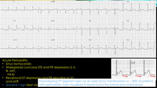 Reference : LITFL ST Segment
Acute Pericarditis:
• Sinus tachycardia
• Widespread concave STE and PR depression (I, II,
III, aVF,
V4-6)
• Reciprocal ST depression and PR elevation in V1
and aVR
• Spodick’s sign best visualised in lead II
Downsloping TP segment seen as an early ECG manifestation in ~30% of patients
with pericarditis, best visualised in leads II and the lateral precordial leads
 