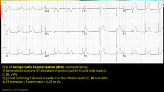Reference : LITFL ST Segment
ECG of Benign Early Repolarisation (BER), demonstrating:
1) Generalised concave ST elevation in precordial (V2-6) and limb leads (I,
II, III, aVF)
2) J-point notching / Slurred is evident in the inferior leads (II, III and aVF)
3) ST elevation : T wave ratio < 0.25 in V6
 