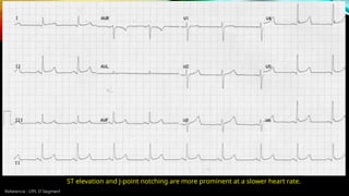 Reference : LITFL ST Segment
ST elevation and J-point notching are more prominent at a slower heart rate.
 