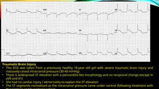 Reference : LITFL ST Segment
Traumatic Brain Injury
• This ECG was taken from a previously healthy 18-year old girl with severe traumatic brain injury and
massively raised intracranial pressure (30-40 mmHg)
• There is widespread ST elevation with a pericarditis-like morphology and no reciprocal change (except in
aVR and V1)
• She had no cardiac injury / abnormality to explain the ST elevation
• The ST segments normalised as the intracranial pressure came under control (following treatment with
 