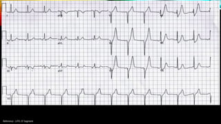 Reference : LITFL ST Segment
 