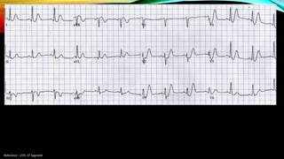 Reference : LITFL ST Segment
 