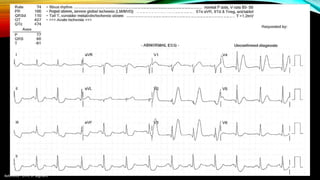 Reference : LITFL ST Segment
 
