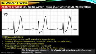 Reference : LITFL ST Segment
De Winter T Wave
-All three previous ECG are De winter T wave ECG = Anterior STEMI equivalent
ECG Diagnostic Criteria
• Tall, prominent, symmetrical T waves in the precordial leads
• Upsloping ST segment depression > 1mm at the J point in the precordial leads
• Absence of ST elevation in the precordial leads
• Reciprocal ST segment elevation (0.5mm – 1mm) in aVR
• Typical STEMI morphology may precede or follow the De Winter pattern
•The de Winter pattern is seen in ~2% of acute LAD occlusions and is often under-
recognised by clinicians
 