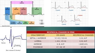 RECIPROCAL CHANGES IN STEMI
STEMI TERRITORY STE LEADS RECIPROCAL CHANGES
SEPTAL / ANTERIOR V1-V2 / V3-V4 II, III, AVF
LATERAL I, AVL, V5-V6 II, III, AVF
INFERIOR II, III, AVF I AND AVL
POSTERIOR V7, V8, V9 V1-V3
 