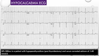 HYPOCALCAEMIA ECG
QTc 500ms in a patient with hypoparathyroidism (post thyroidectomy) and serum corrected calcium of 1.40
mmol/L
 