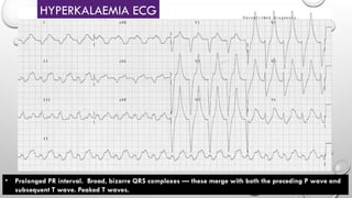 • Prolonged PR interval. Broad, bizarre QRS complexes — these merge with both the preceding P wave and
subsequent T wave. Peaked T waves.
HYPERKALAEMIA ECG
 